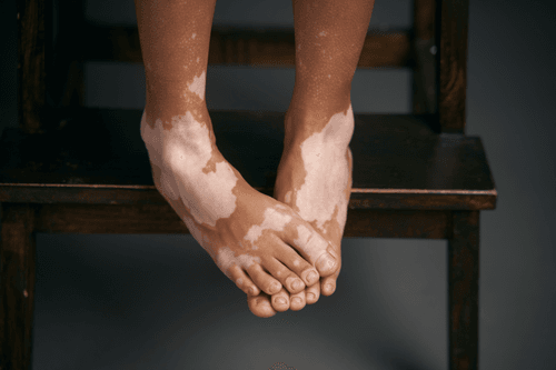 Vitiligo Girl