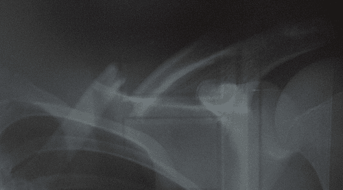The story of the fracture and healing of my collarbone.